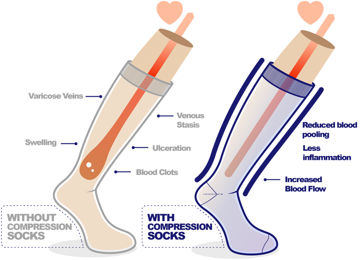 Compression Socks: The Right Compression - Sox Solution – SOX SOLUTION