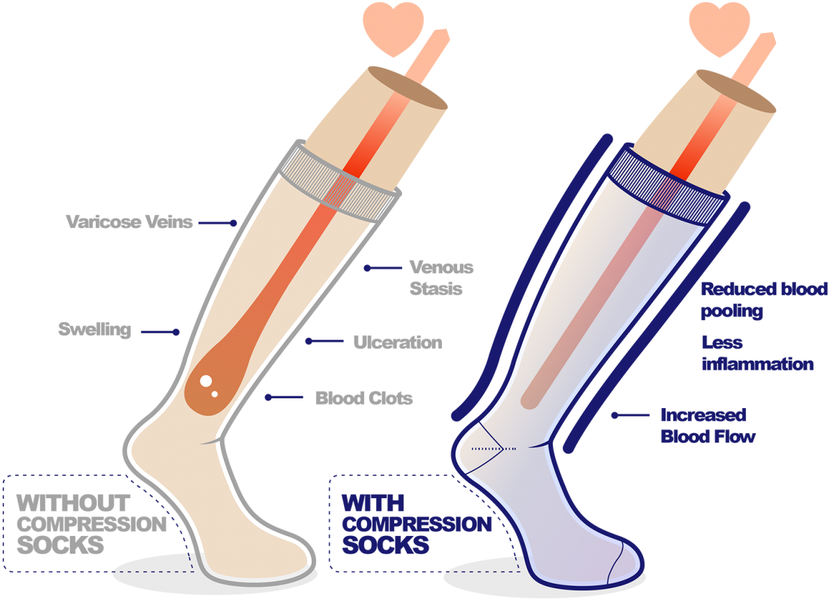 Diagram showing how compression socks work
